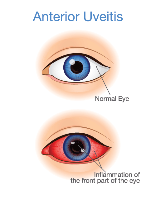 eye inflammation lyme disease